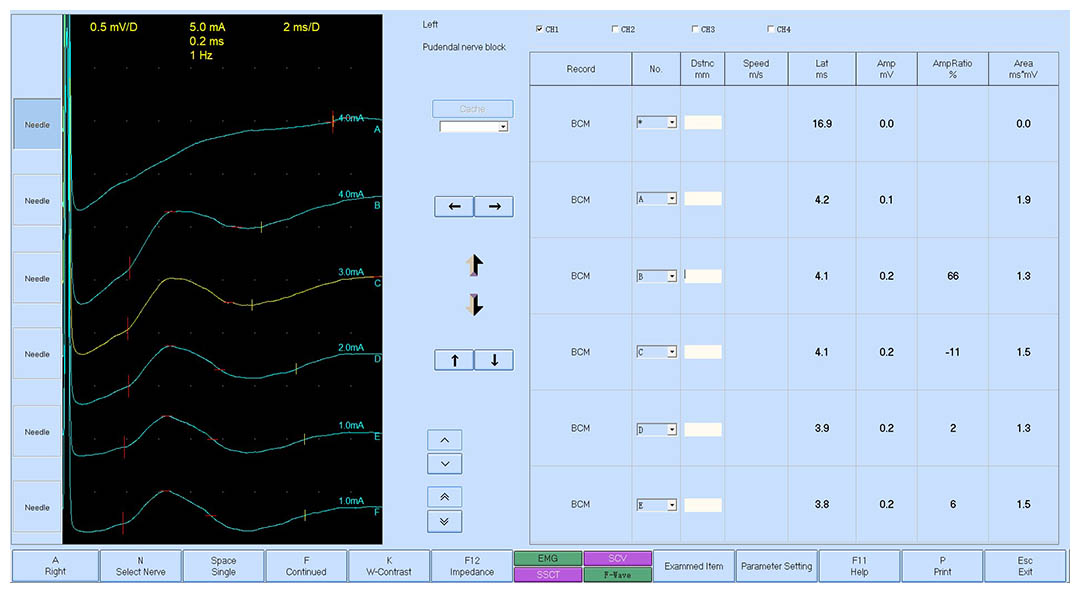 ics-2019-abstract-363-pudendal-nerve-block-under-non-invasive