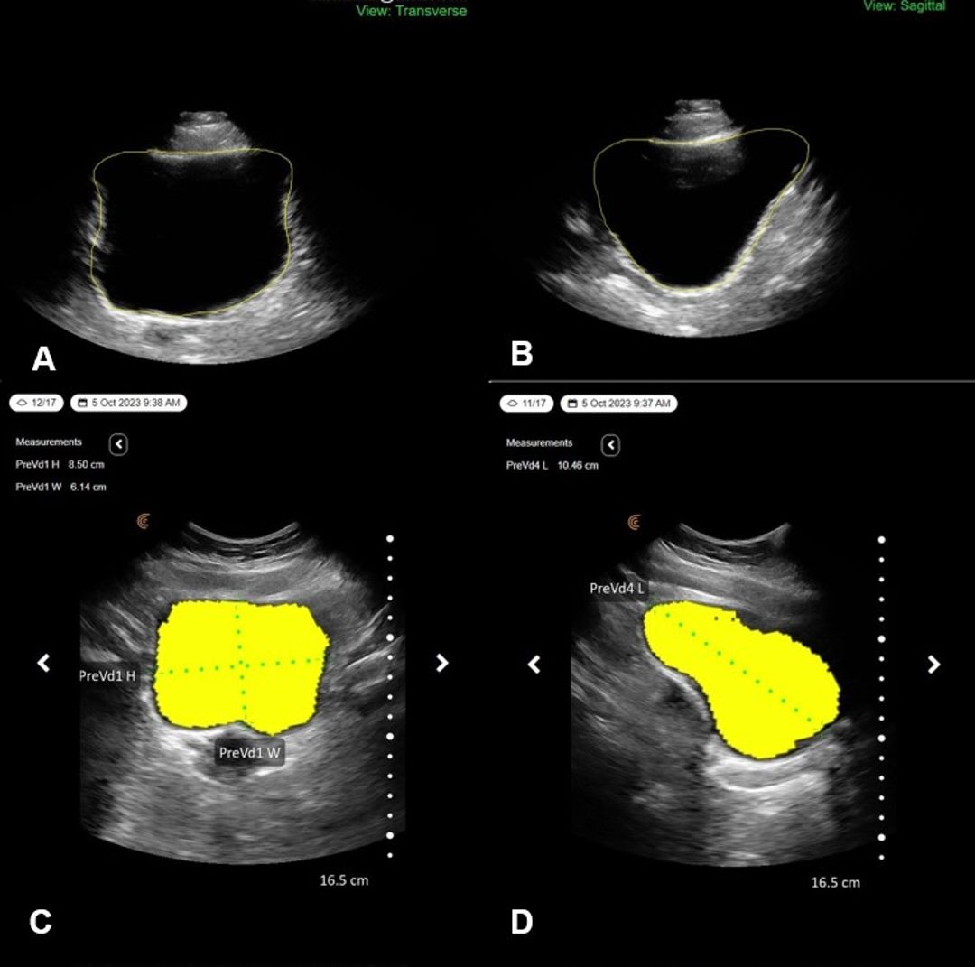 ICS 2024 Abstract #644 A Deep Learning Model to automate bladder volume ...