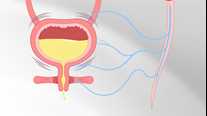 Neurogenic Bladder